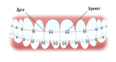Элементы брекет-системы