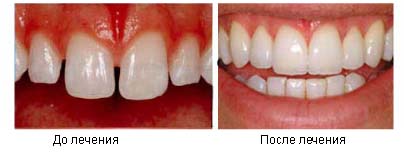 До и после лечения брекетами