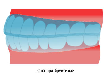 Защитная капа при бруксизме.