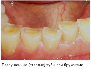 Скрежетание зубами во сне, последствия.