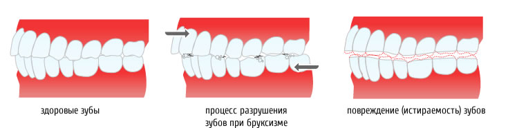 Скрежетание зубов во сне. Бруксизм.