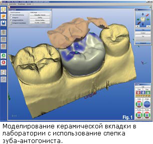 CAD-CAM моделирование керамической вкладки в лаборатории.