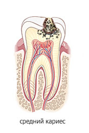 Средний кариес