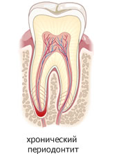 Хронический периодонтит