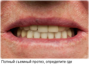 Установленный съемный протез