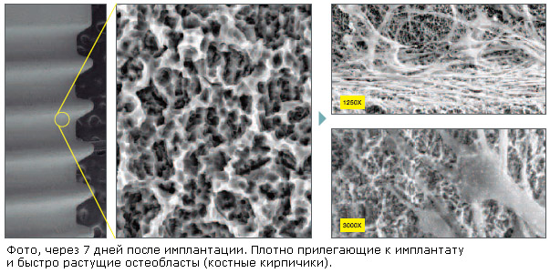 Процесс остеоинтеграции dentium syperline