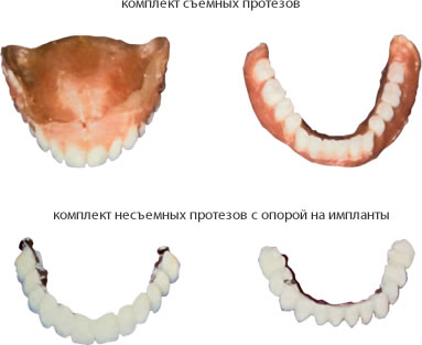 Размеры протезов на имплантатах меньше, чем у аналогичных, опирающихся на мягкие ткани.