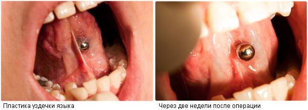 Результат операции иссечения уздечки языка