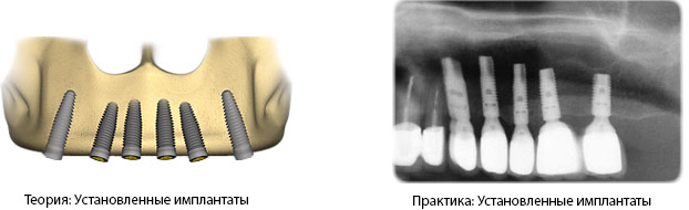 Полная имплантация. Установка имплантов.