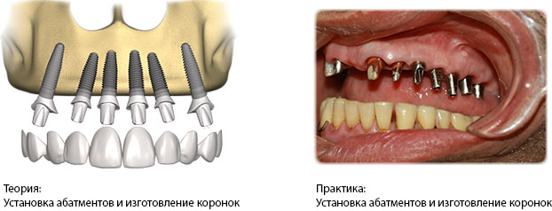  Полная имплантация. Установка абатментов 