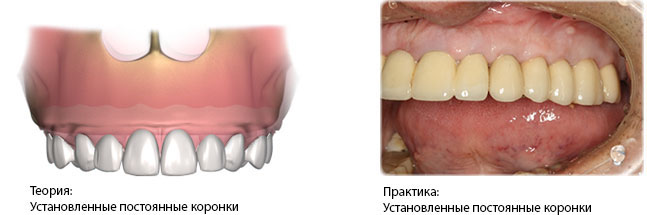  Полная имплантация. Протезирование на имплантатах.