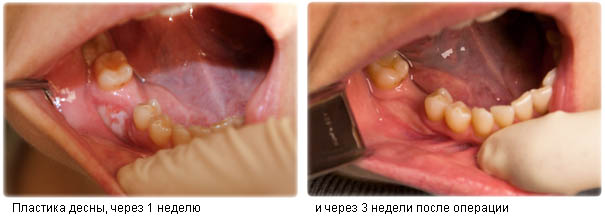Десна через 1 и 3 недели после операции