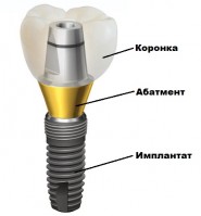 Имплантация зубов под ключ