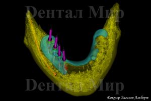 3D-моделирование имплантации на нижней челюсти