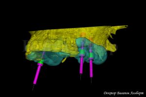 3D-моделирование имплантации на нижней челюсти