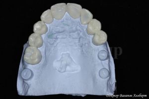 Модель верхней челюсти с моделями зубов. Видны головки формирователей
