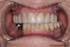 Mock up. Моделирование будущих зубов в полости рта. Применение ретрактор