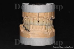 Постоянные металлокерамические коронки на модели.