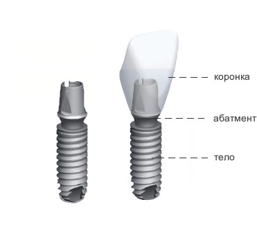 Конструкция импланта