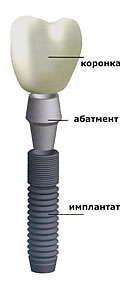 Имплантант