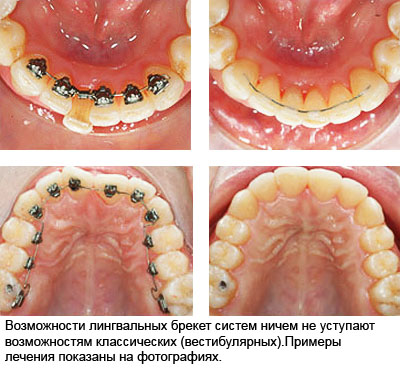 Лингвальные брекеты до и после