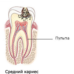 Средний кариес