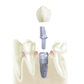 Имплантация одного зуба