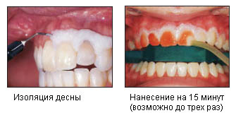 Изоляция десен и нанесение геля