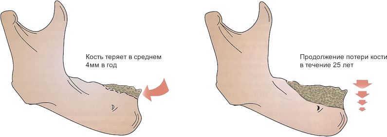 Резорбция костной ткани