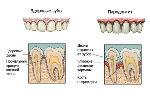 Имплантация при пародонтите