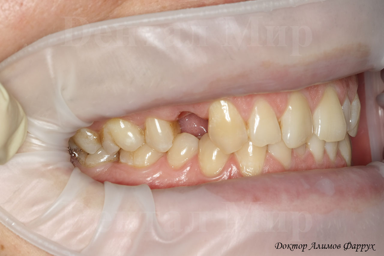 Фото после удаления зуба справа