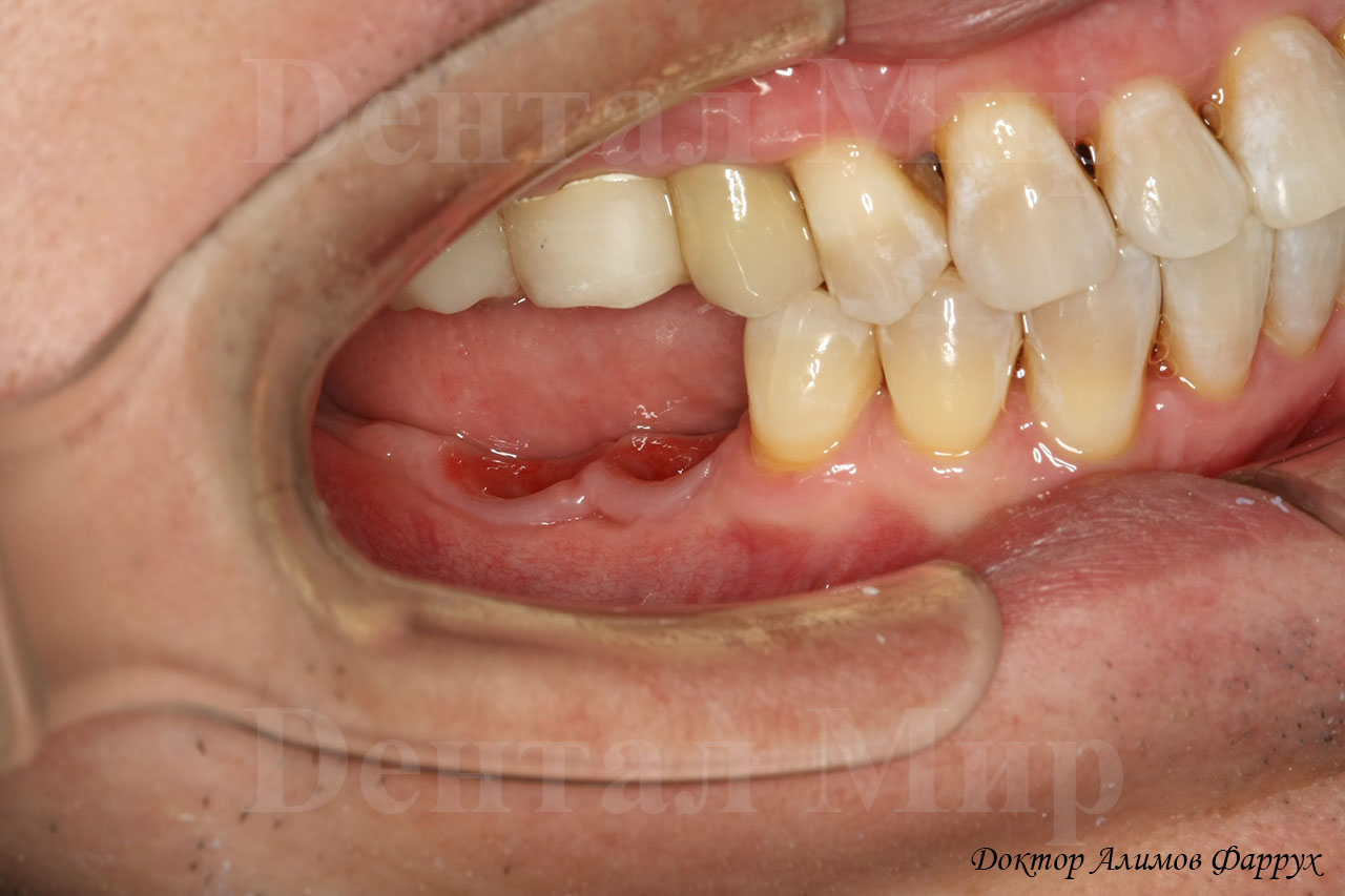 Фото после удаления зуба справа. Видны пластмассовые коронки на верхней челюсти