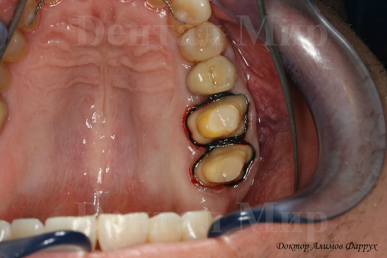 Обточка зубов с уступом