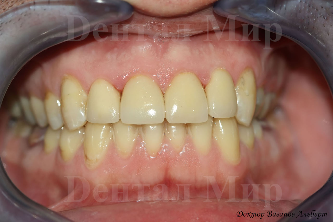 Четыре безметалловые коронки на фронтальных зубах