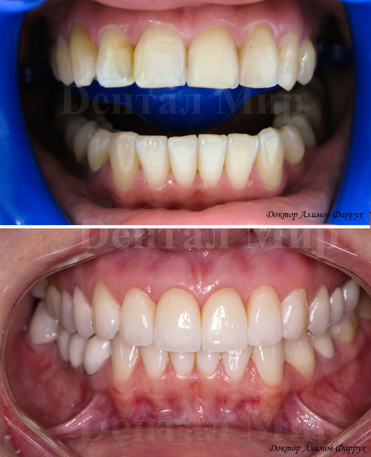 Отбеливание зубов и установка 4 керамических виниров до и после