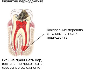 Периодонтит