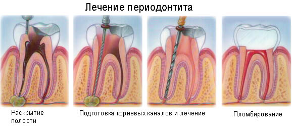 Этапы лечения периодонтита