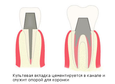 культевые вкладки, служат опорой для коронки