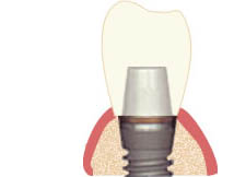 Одиночный протез на имплантате