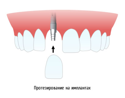 Протезирование на имплантатах