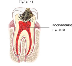 Пульпит