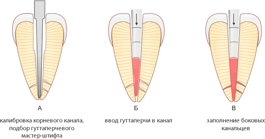 Метод инъекции жидкой гуттаперчи