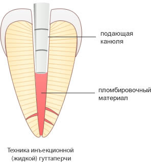 пломбирование корневого канала методом вертикальной конденсации