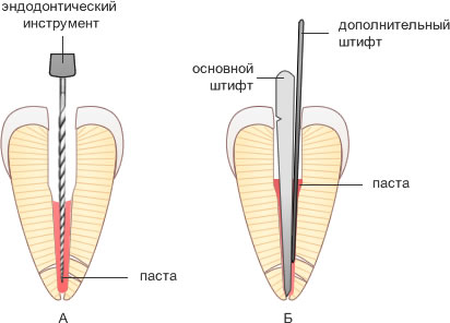 пломбирование корневого канала методом латеральной конденсации