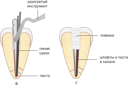 пломбирование корневого канала методом латеральной конденсации