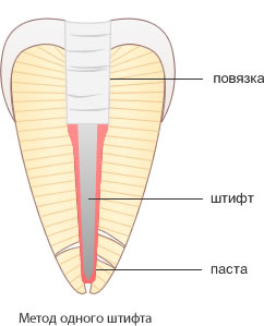 пломбирование корневого канала методом одного штифта