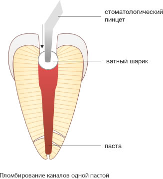 пломбирование корневого канала одной пастой