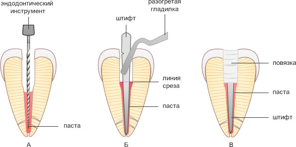 пломбирование корневого канала методом одного штифта