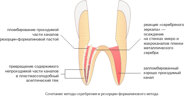 пломбирование корневого канала сочетанием метода серебрения и резорцин-формалинового метода 