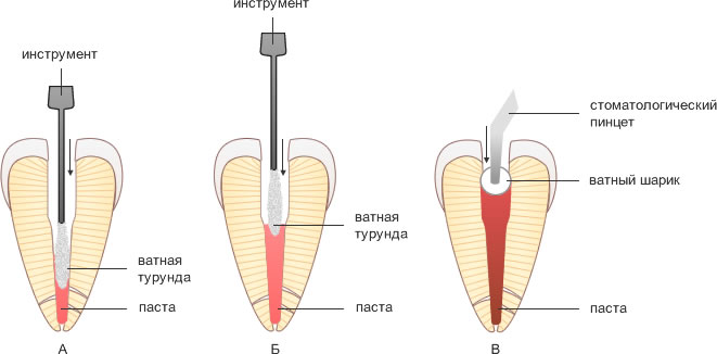 пломбирование корневого канала одной пастой